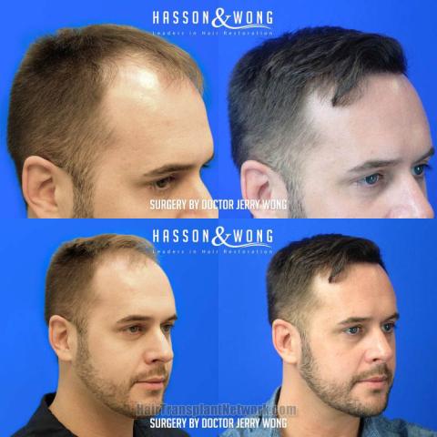 Hair transplantation procedure before and after results