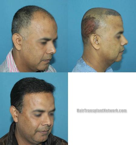 Hair restoration procedure after result images