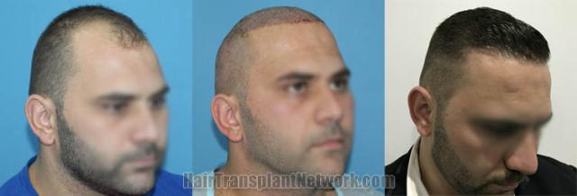 Hair restoration procedure before and after results