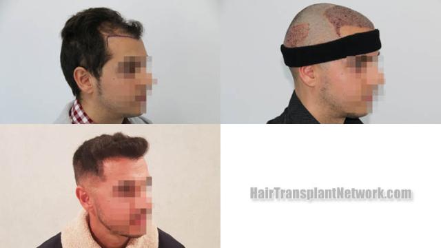 Hair transplantation procedure before and after results