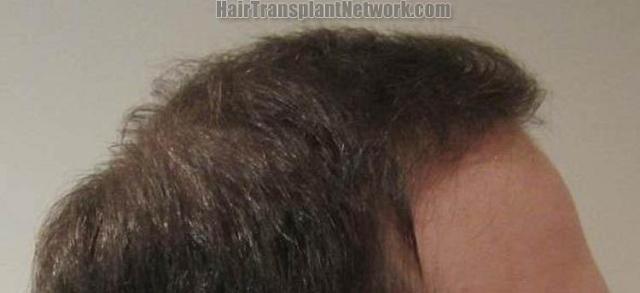 Hair transplantation surgery before and after images