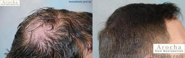 Hair restoration procedure results