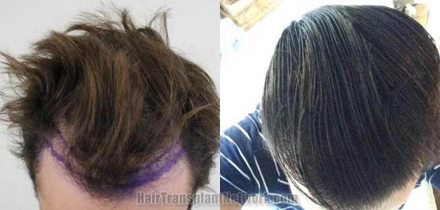 Hair transplantation surgery before and after photos