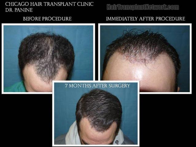 Top view before and after hair restoration