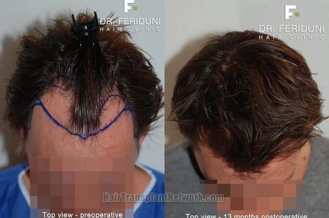 Hair transplantation surgery before and after photos