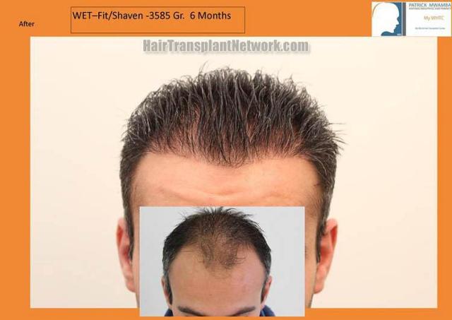 Hair transplantation surgery before and after photos