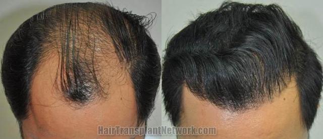 Hair transplantation surgery before and after photos