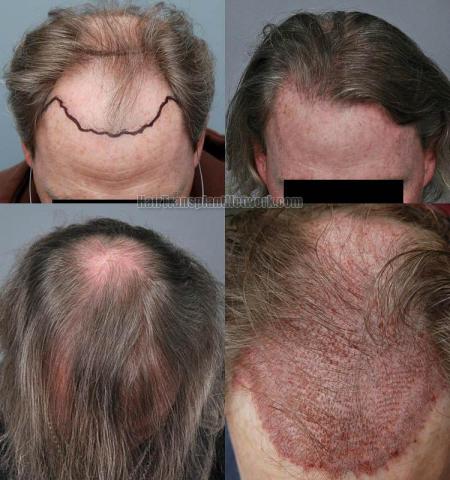 Hair restoration procedure before and after results