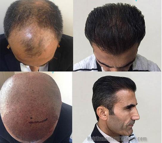 Hair transplantation surgery before and after pictures