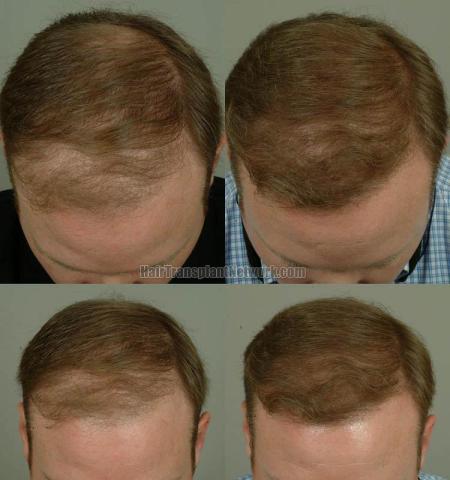 Hair transplantation surgery before and after photos