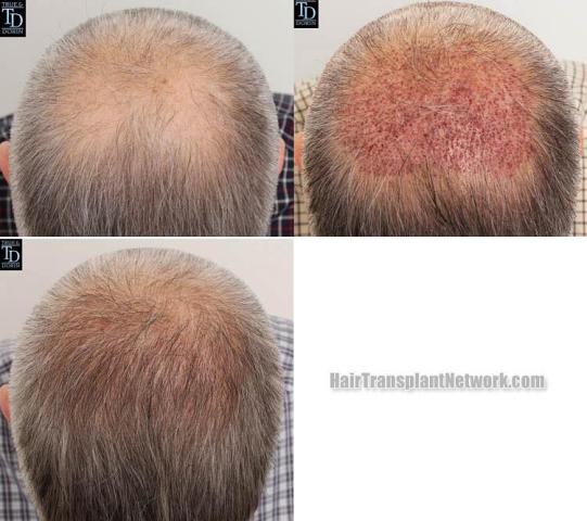 Hair restoration procedure before and after results