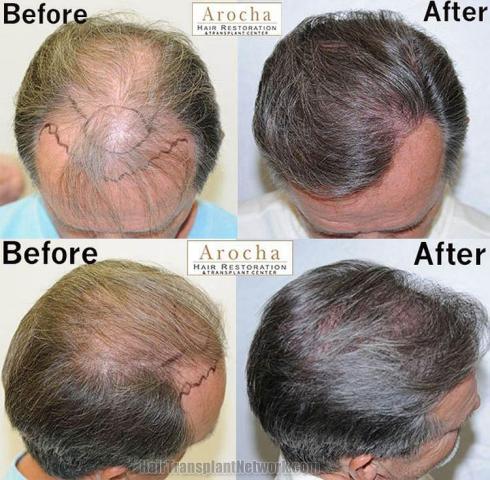 Hair restoration procedure before and after results