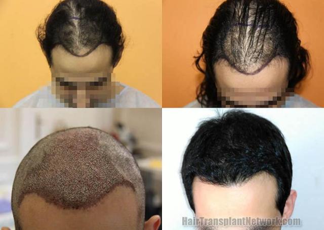 Hair restoration procedure before and after results