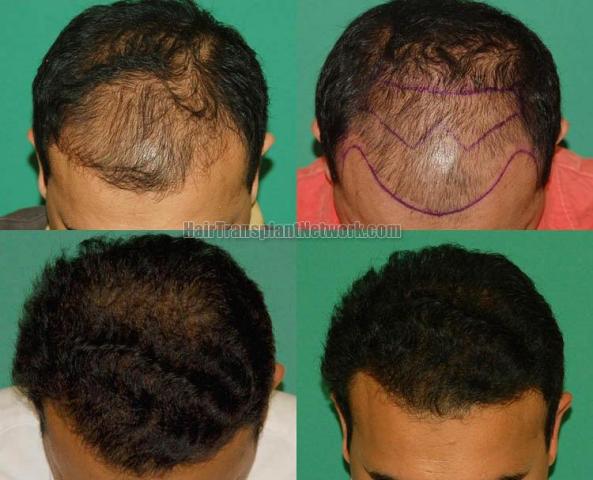 Top view before and after hair restoration results