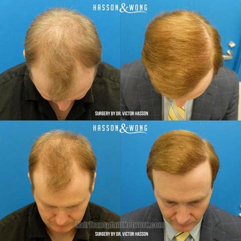 Hair transplantation surgery before and after pictures