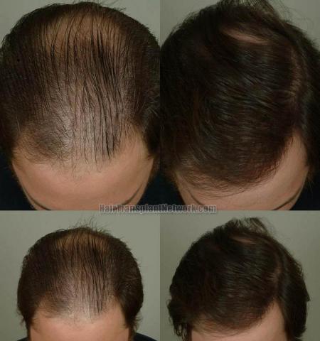 Hair transplantation surgery before and after photos