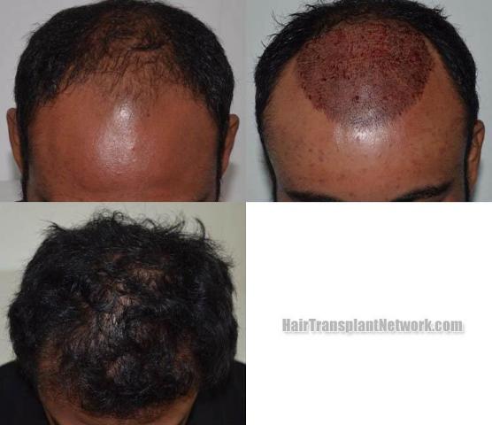 Hair transplantation surgery before and after photos