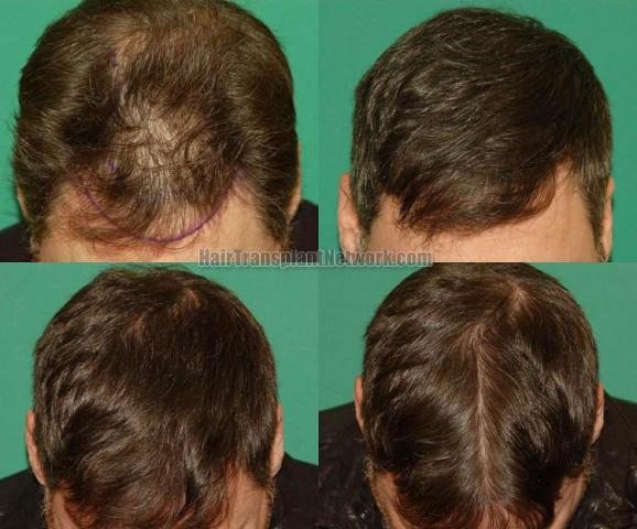 Hair restoration procedure before and after results