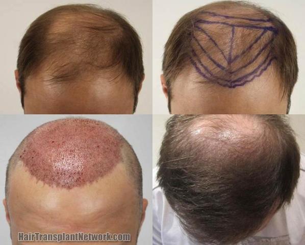 Hair restoration procedure before and after results