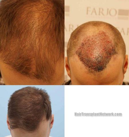 Top view before and after hair restoration results