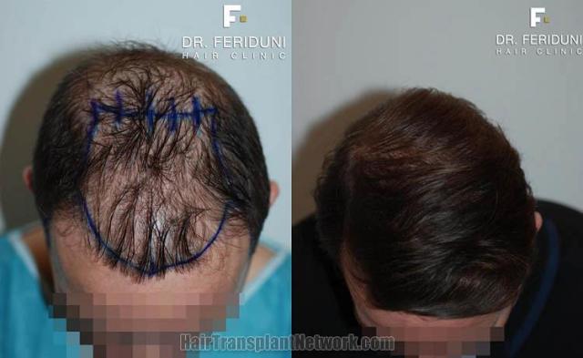 Hair restoration procedure before and after result photos