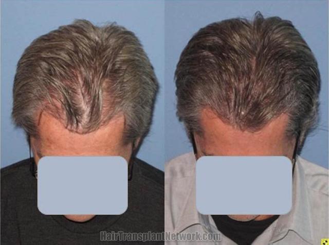 Hair restoration procedure before and after results