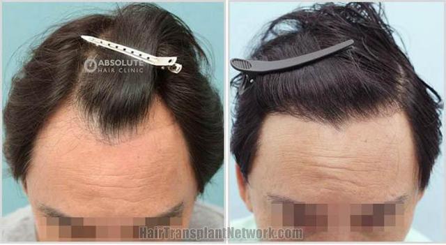 Front view - Before and after hair transplantation surgery