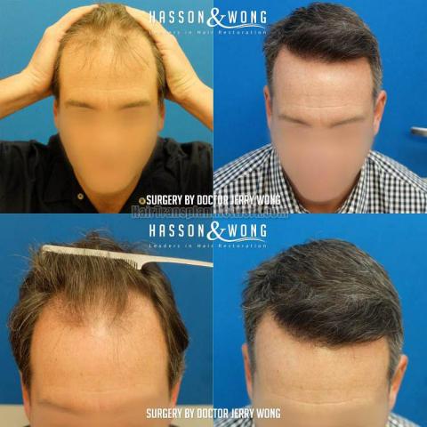 Before and after hair restoration procedure images