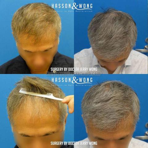 Before and after hair restoration procedure images