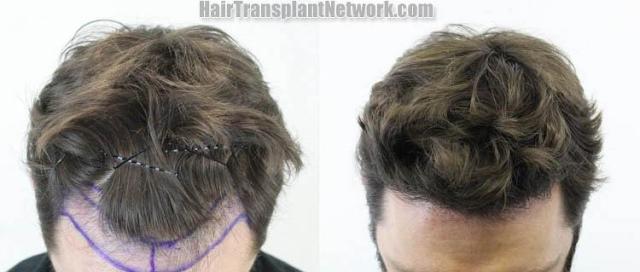 Hair transplantation surgery before and after images