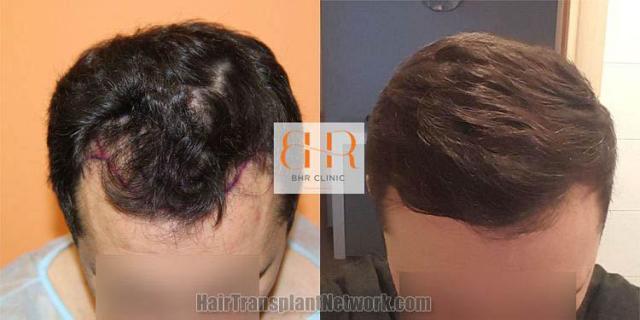 Hair transplantation surgery before and after images