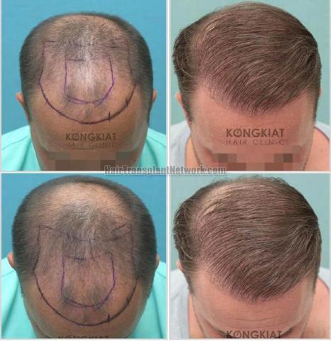 Hair restoration procedure before and after photo results