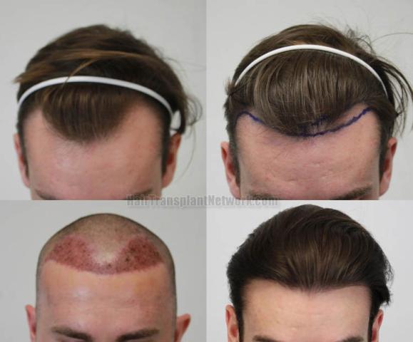 Hair transplantation surgery before and after images