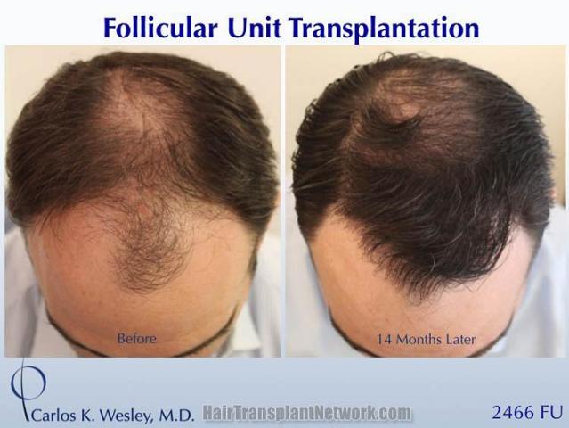 Hair restoration procedure before and after results