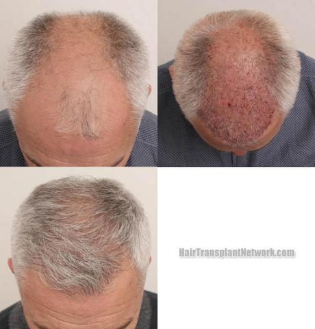 Hair transplantation surgery before and after images