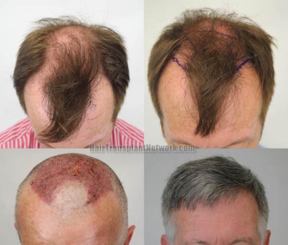 Hair transplantation surgery before and after images