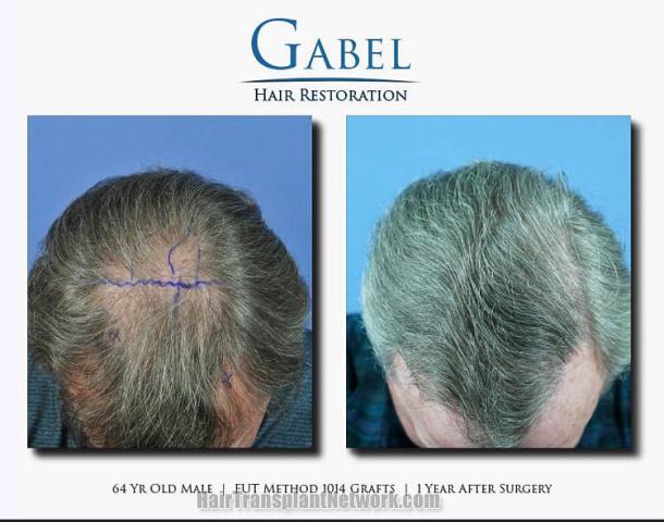 Hair transplantation surgery before and after images