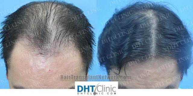 Before and after hair restoration procedure images