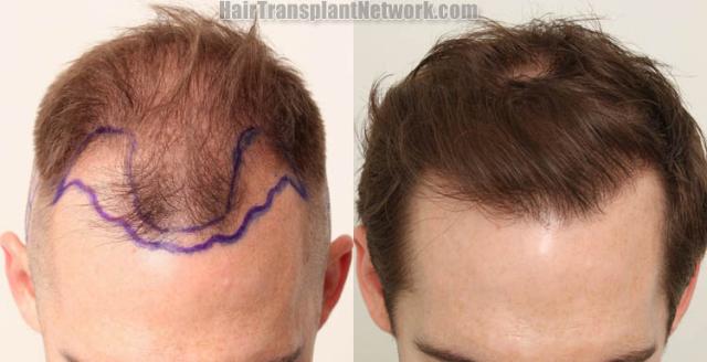 Before and after hair restoration procedure images