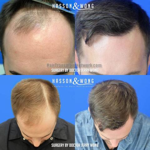 Before and after hair restoration procedure images