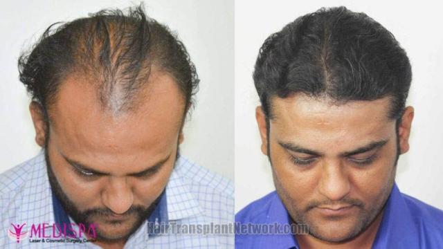 Hair transplantation surgery before and after images