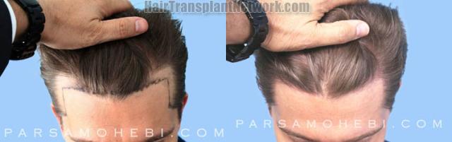 Hair transplantation surgery before and after images