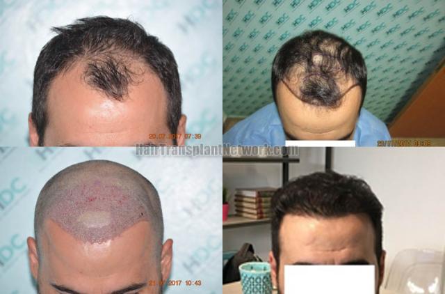 Before and after hair restoration procedure images