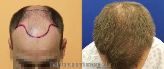 Hair transplantation surgery before and after images