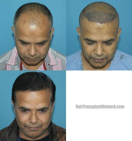 Before and after hair restoration procedure images