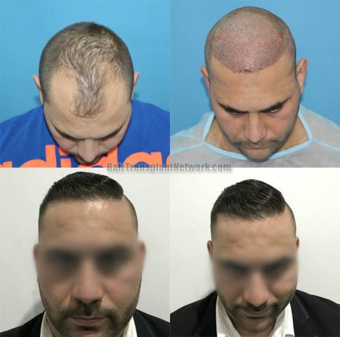 Hair transplantation surgery before and after images