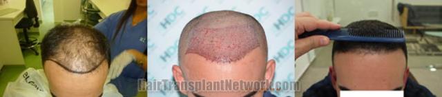 Before and after hair restoration procedure images