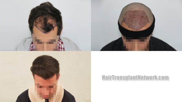 Before and after hair restoration procedure images