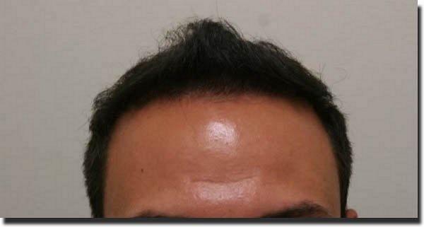 Hair restoration procedure results