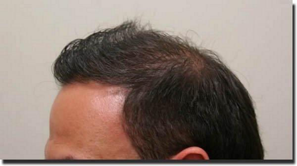 Hair restoration procedure results